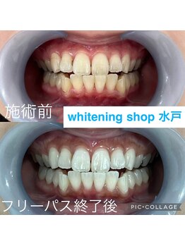ホワイトニングショップ 水戸駅前店/#水戸ホワイトニング#水戸エステ