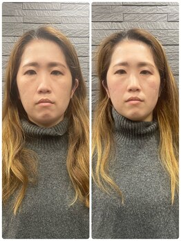 長寿鍼灸院 長寿整骨院/美容鍼25本の効果★毛穴改善