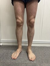 ブリッジ(BRIDGE)/メンズ全身脱毛6回目