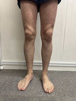 ブリッジ(BRIDGE)/メンズ全身脱毛6回目