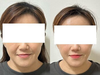 シアワセ(shiAwase)/【大阪本町】小顔矯正 B/A変化