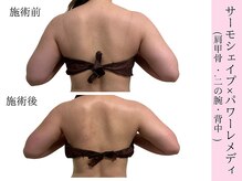 ラエッセ(La Esse)/二の腕すっきり！！