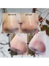 ララチッタ(L'la citta)/毛穴の黒ずみが気になる方に！