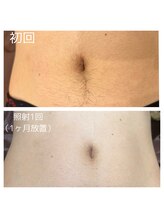 ダリオムズ 西宮北口(DAHLI HOMMES)/☆メンズヘソ下脱毛☆施術1回目