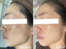 パールホワイトニングサロン 小田原店/くすみ/毛穴/シミしっかりケア