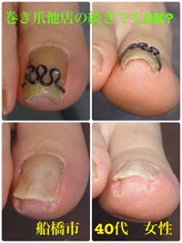 巻き爪じゅん 千葉駅前店/巻き爪他店の器具付いてて可能？