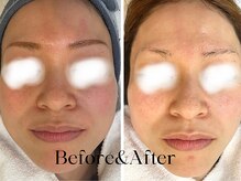 トウキョウビューティーラボ(TOKYO BEAUTY LABO.)/スノーピールBefore&After