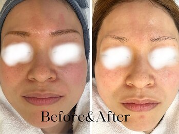 トウキョウビューティーラボ(TOKYO BEAUTY LABO.)/スノーピールBefore&After