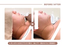 イエス マイサロン(yes My Salon)/レモンボトル施術例
