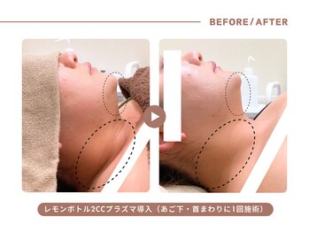 イエス マイサロン(yes My Salon)/レモンボトル施術例