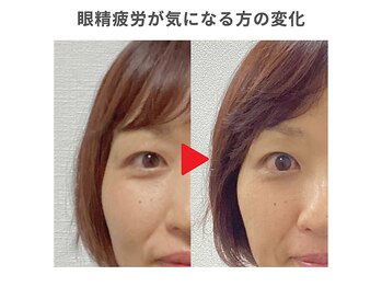 ひもとき整体院/美容鍼で眼精疲労へアプローチ