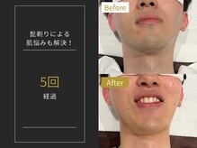 ステイゴールド 新百合ヶ丘(STAY GOLD)/おヒゲ脱毛の経過☆