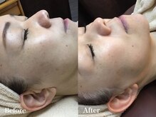 ラウレア 西条店(LAULEA)/光フェイシャルbefore/after