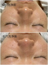 クロッシュ(Cloche)/ハイドラ毛穴洗浄・毛穴ケア