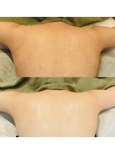 リム ビューティー(RYM BEAUTY)/背中ニキビにボディダクトピール