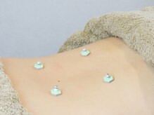 ジェネラス 鍼灸院 整骨院(GENEROUS)/腰へお灸