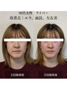 ザ リフト カドモリ 鹿児島 霧島(The Lift KADOMORI)/30代女性/面長、左右差