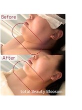 Blossom 【ホワイトニング/脱毛/韓国肌管理/毛穴洗浄】【3/23 NEW OPEN(予定)】/REDSHOT　顎下