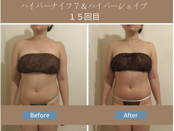 漢方アロマヒーリングサロン 浦和店(漢方AROMAヒーリングサロン)/ハイパーナイフ7&シェイプ15回