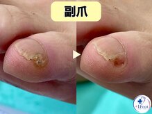 プラスワンフット 本厚木(+1 Foot)/痛い・引っかかる・邪魔な副爪に