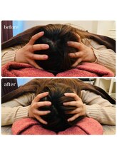 エクスター(EXTR)/頭蓋骨小顔矯正