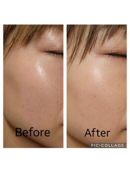 エムスラッシュアヴェダ 自由が丘(M.SLASH AVEDA)/シミケア　薄いシミまぶた上