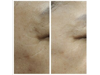 ルミエール(Lumiere)/シワケアで薄く♪