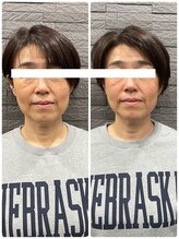 長寿鍼灸院 長寿整骨院/美容鍼50本の効果★小顔効果