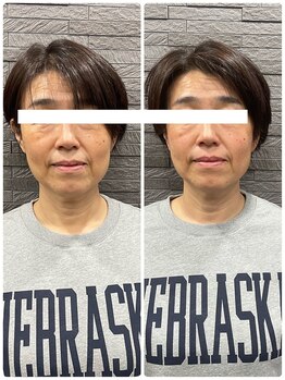 長寿鍼灸院 長寿整骨院/美容鍼50本の効果★小顔効果