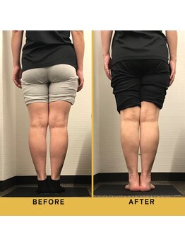 ベル/【50代会員様】O脚矯正の変化