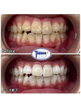 ティースペース 蒲郡店(T-space)/クリスタルWhite Plus