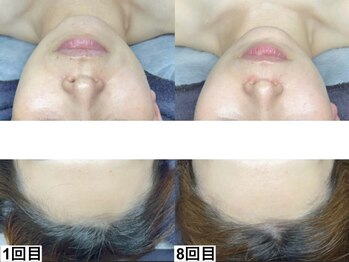 アンドミー 小倉(&me)/ララピールでゆらぎ肌を整えます