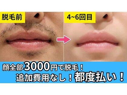 脱毛エクスプレスの写真
