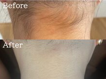 ルナステラ 七尾店/LEDローズ脱毛