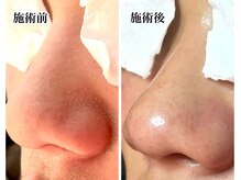 ラロリ(Laloli)/毛穴洗浄コース