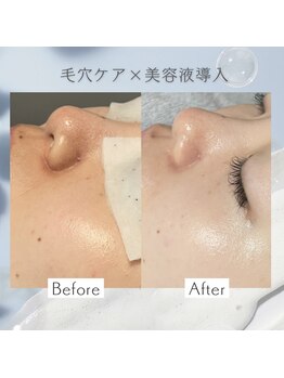 リアン(Lien)/【症例】毛穴ケア×美容液導入