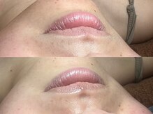 ゴールデンエイジ 吉祥寺(GOLDEN AGE)/ワックス脱毛 : 施術