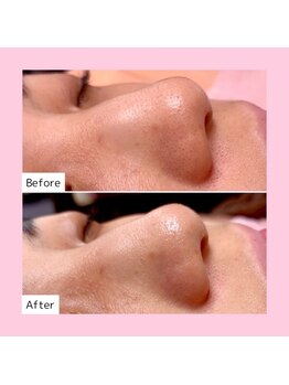 ホワイトラボ 新潟万代(White labo)/【施術例】ハイドロフェイシャル