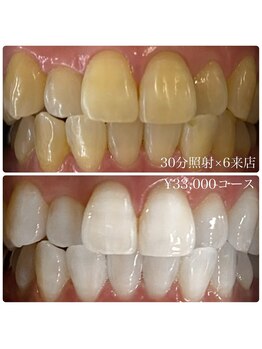 ホワイトニングルーム 川崎店(WhiteningRoom)/ホワイトニング/川崎