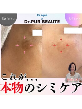 エステティックサロン ラ アクア(ra aqua)/本物のシミケアはここまで変わる