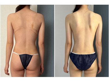 モア(moa)/肩こりスッキリ