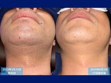父さん専用ヒゲ脱毛の店/脱毛比較写真　＃メンズ脱毛