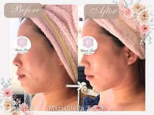 マリスステラ 天王寺(MarisStella)/1回でフェースラインスッキリ！