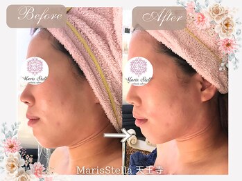 マリスステラ 天王寺(MarisStella)/1回でフェースラインスッキリ！
