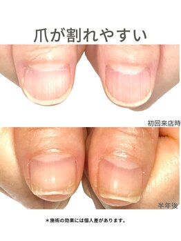 40代/爪が割れやすい/アフター