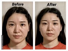 ショウフェイスデザイン(Sho Face Design)/《小顔矯正》ビフォーアフター