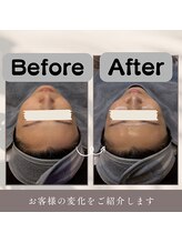 ケーブロッサムビューティーサロン(K Blossom Beauty Salon)/水光３Dピール(ビフォ.アフター)