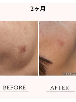 ハートエルボー(Heart elbow)/長年、改善されなっかたシミ