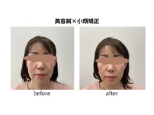 ブライト鍼灸整体院(Bright鍼灸整体院)/美容鍼　小顔矯正　リフトアップ