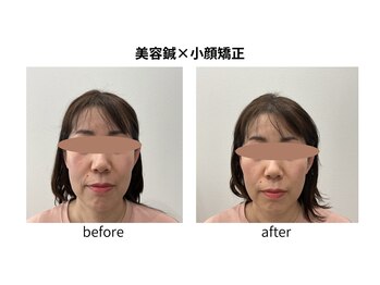 ブライト鍼灸整体院(Bright鍼灸整体院)/美容鍼　小顔矯正　リフトアップ